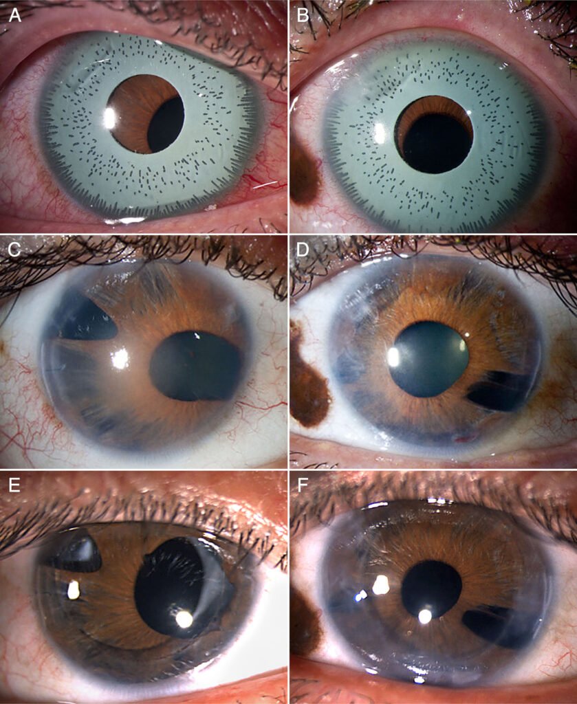 Iris Implant Surgery Dangers: What You Need to Know Before Considering This Risky Procedure