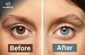 Types of Eye Color Change Surgery: A Complete Guide to Permanent Options