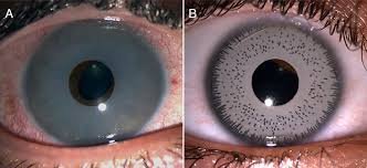 What Are Silicone Iris Implants and How Do They Work?